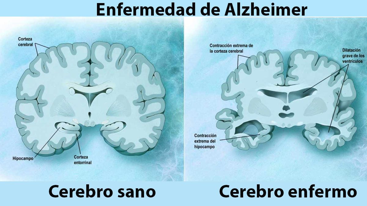 Un cerebro sano y otro enfermo con el mal de Alzheimer (Foto: gentileza El Independiente).