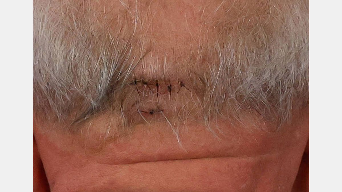 Luego de la caída en el baño, Lula regresó al trabajo con una cicatriz de varios puntos en su nuca. (foto:Gentileza Folha de Sao Paulo)