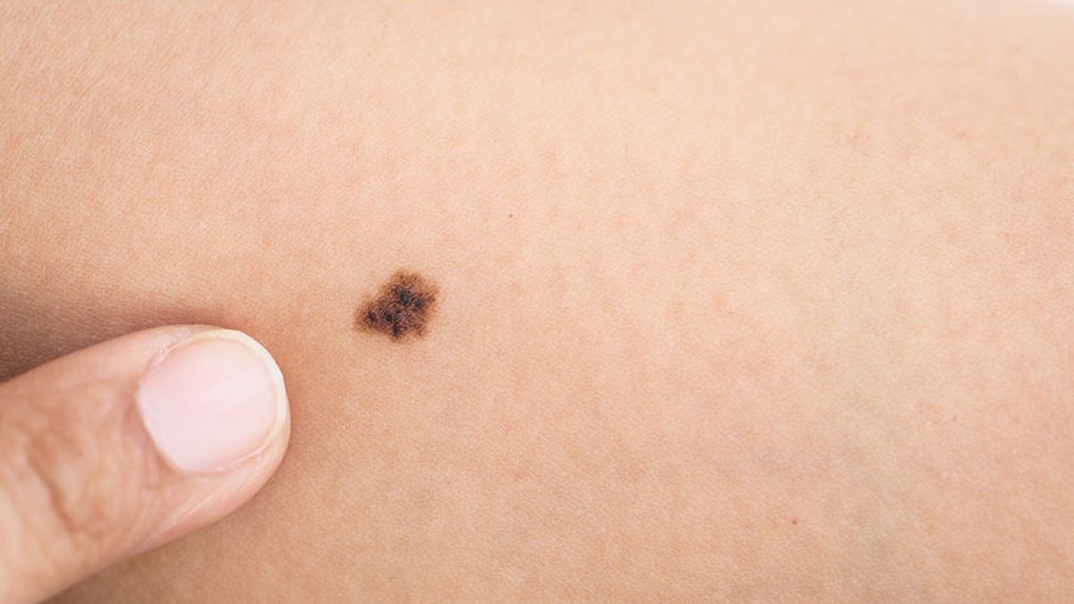 La revisión de los lunares y la protección frente al sol son clave para detectar a tiempo un melanoma y reducir el riesgo de cáncer de piel.