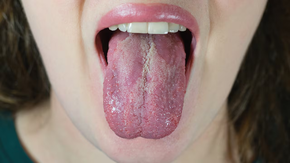 Qué significa tener la lengua blanca y cómo prevenirlo Qué significa tener la lengua blanca y cómo prevenirlo