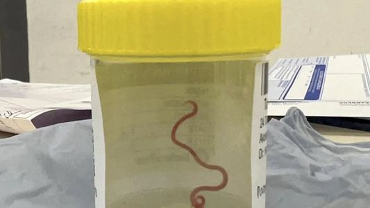 Una mujer sufría síntomas y los médicos no lograban tratarla: encontraron que tenía un gusano vivo en el cerebro