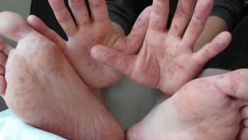 Alertan por casos de enfermedad de manos, pies y boca en jardines bonaerenses: ¿cuáles son sus síntomas?