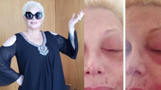 Las impactantes imágenes del rostro de Carmen Barbieri con culebrilla