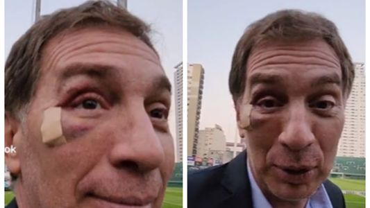 El accidente de Diego Santilli en el que casi pierde el ojo