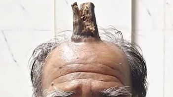 Se golpeó la cabeza y le creció un tronco de árbol en la herida