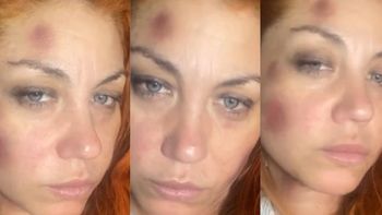 lourdes de bandana denuncio a su ex novio por violencia y mostro su cara golpeada