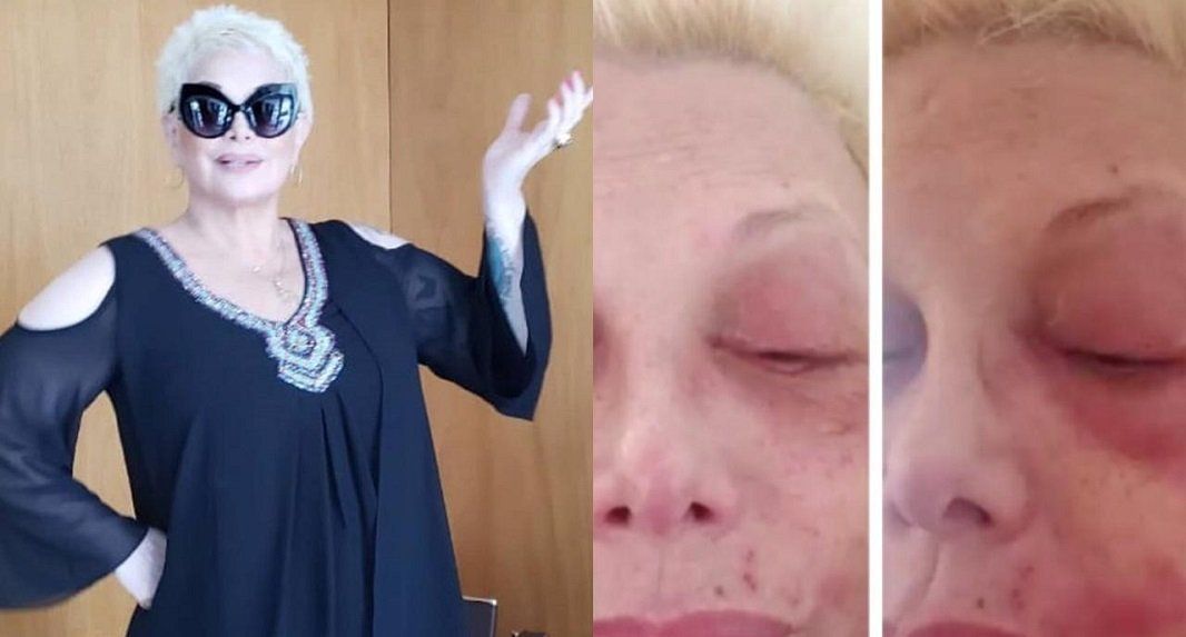 Las impactantes imágenes del rostro de Carmen Barbieri con culebrilla