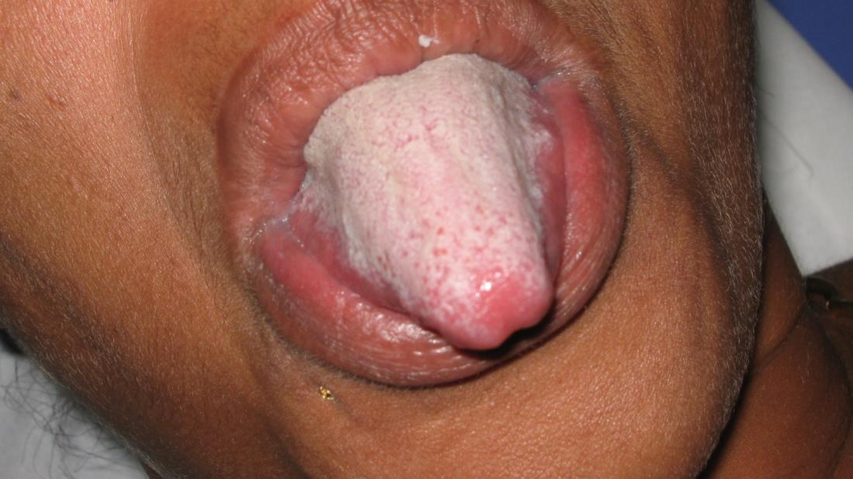 Qué significa tener la lengua blanca y cómo prevenirlo Qué significa tener la lengua blanca y cómo prevenirlo