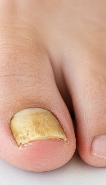 Hongos en las uñas de los pies: por qué se producen y qué hacer para que desaparezcan