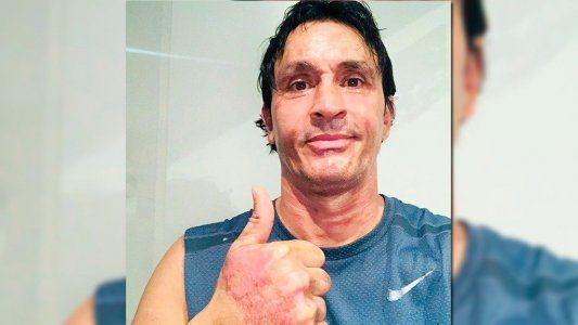 Sebastián Estevanez mostró cómo se recupera tras el accidente doméstico que le provocó quemaduras
