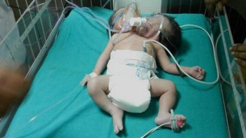 Una pareja que esperaba mellizos dio a luz un bebé con dos cabezas