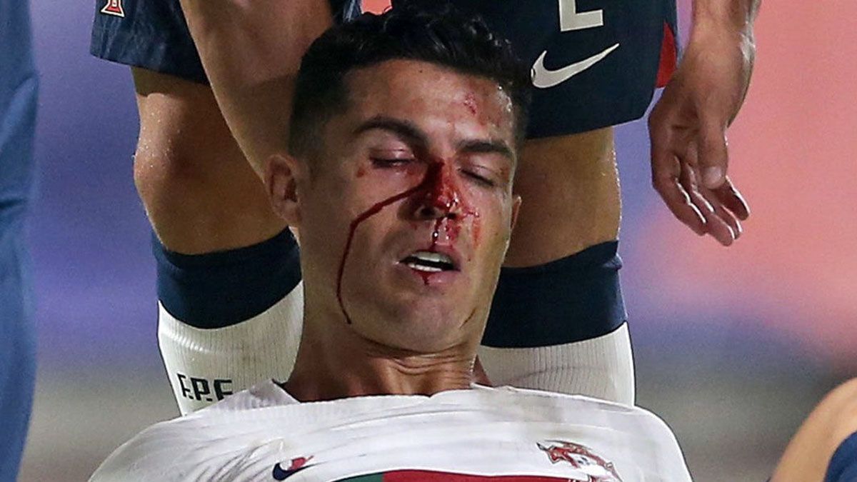 Cristiano Ronaldo sufrió un duro golpe y asustó a todos.&nbsp;