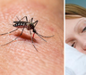 Brote histórico de dengue en Argentina: cómo diferenciar los síntomas del Covid-19