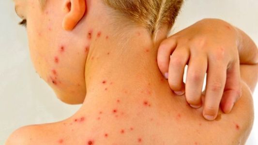 Tras la confirmación de un caso en la Ciudad, investigan un posible contagio de sarampión en un niño en Ensenada