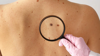 Lunares peligrosos: cómo detectarlos a tiempo con un sencillo autoexamen
