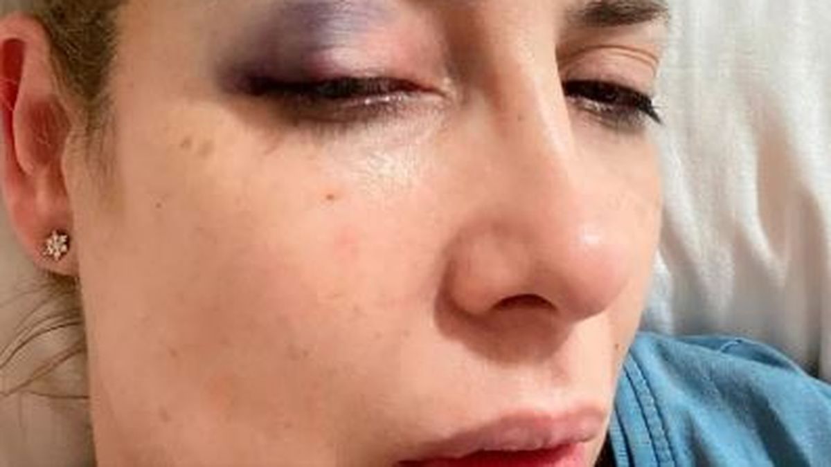 Fabiola Y&aacute;&ntilde;ez con un moret&oacute;n en el ojo.