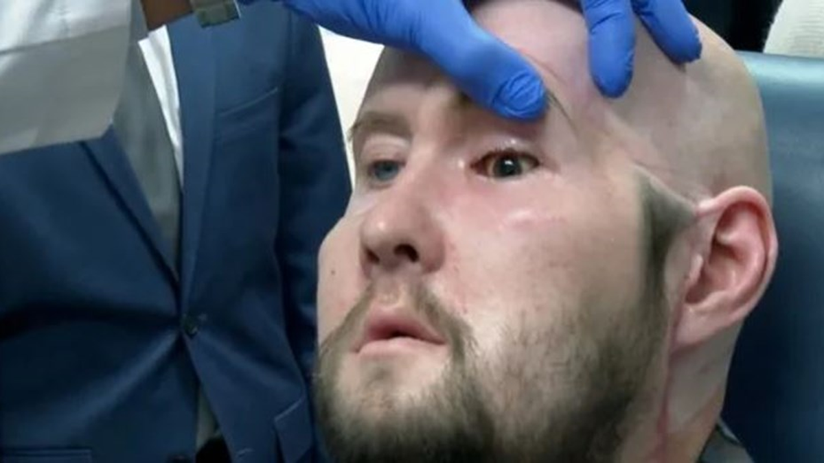 Cómo fue el primer trasplante de ojos del mundo