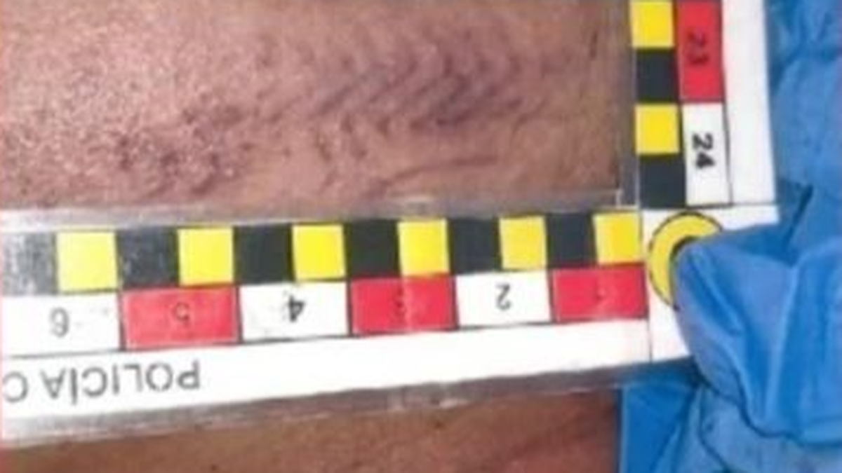 Fernando Báez Sosa tenía una marca de 6 centímetros en el mentón producto de una patada.&nbsp;