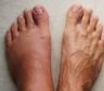 Pies, tobillos y piernas hinchados: las causas más frecuentes y cuándo puede ser una señal de alerta