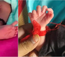 Conmoción: nació una niña con 26 dedos