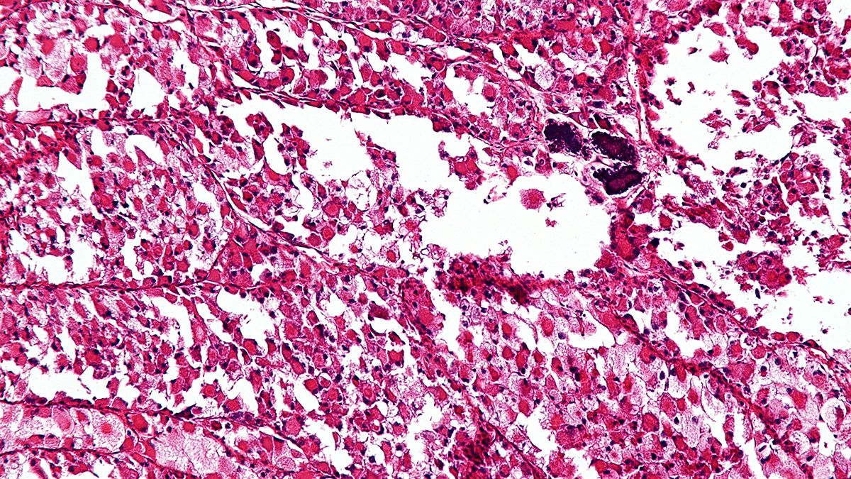 Cada 13 de julio se conmemora el Día Internacional del Sarcoma. (Foto: Wiki Commons)