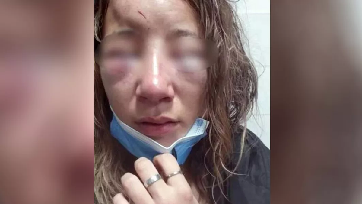 La mujer hizo su descargo en redes sociales mostrando las fotos de cómo quedó después de la golpiza que le propinaron dos mujeres trans