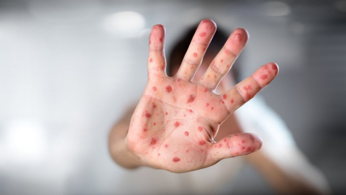 Viruela del Mono: la Organización Mundial de la Salud&nbsp;(OMS) elevó el nivel de riesgo de la enfermedad a moderado por los 550 contagios detectados en 30 países (Foto: archivo).