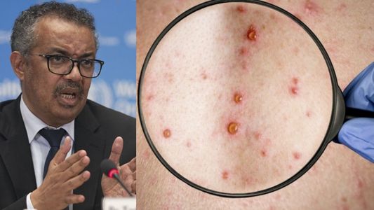 Viruela del mono: la OMS vuelve a discutir si declara la emergencia por la suba de casos