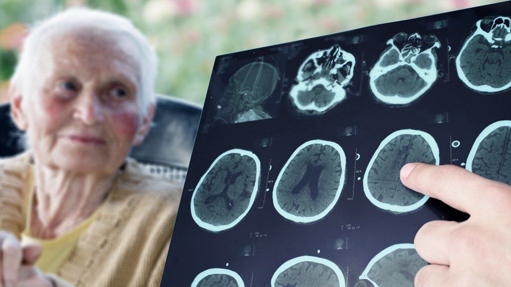 Descubren un gen que estaría relacionado con el riesgo a desarrollar Alzheimer