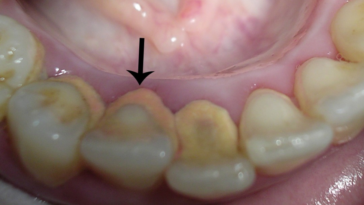 DILE adiós al sarro de los DIENTES con este trucazo casero DILE adiós al sarro de los DIENTES con este trucazo casero