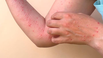 Emergencia mundial por la viruela del mono: el Gobierno reforzará controles en aeropuertos