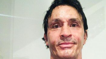 Sebastián Estevanez habló del accidente doméstico que tuvo: Me confié, cometí un error