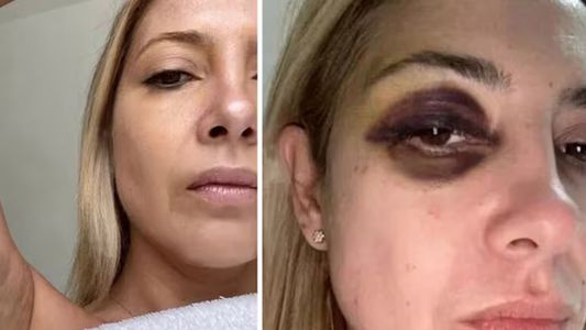 Se conocieron las fotos de la denuncia de Fabiola Yáñez contra Alberto Fernández: Venís golpeándome hace tres días seguidos