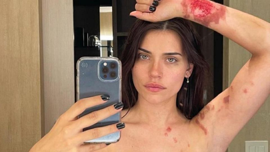 Eva De Dominici mostró fotos del terrible accidente que sufrió: Me explotó al lado