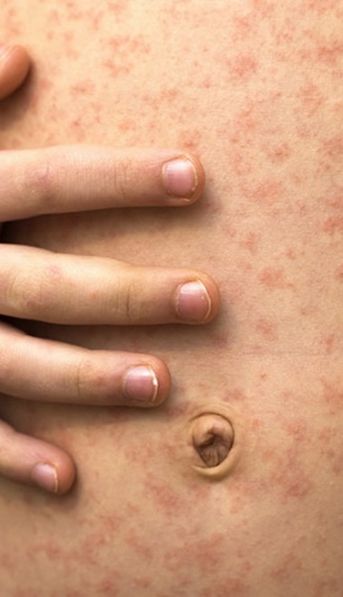 Contagios, síntomas y vacunas contra la viruela del mono: todas las respuestas sobre la enfermedad