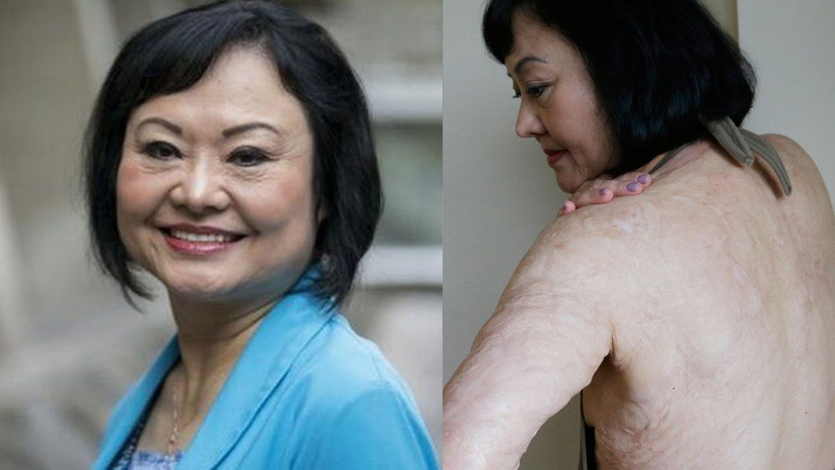 Necesitó decenas de operaciones para curar parte de su piel con injertos. Aún hoy, siente dolor y continúa en tratamientos para recuperar sensibilidad. (Foto: A24.com)