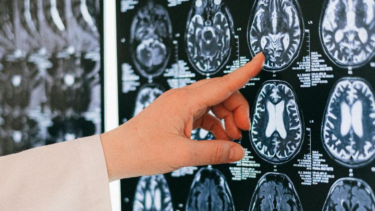 El cerebro no desarrolla m&aacute;s casos de tumores por el uso prolongado de los celulares concluy&oacute; la OMS. (Foto: Gentileza IMER)