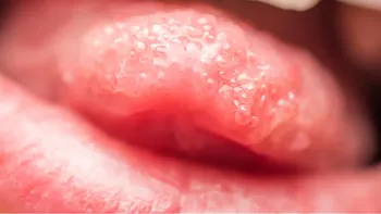 La disgeusia metálica puede estar asociada a infecciones, problemas dentales, deficiencias nutricionales o efectos secundarios de medicamentos.