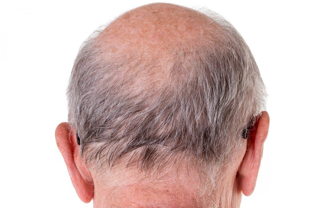 Un equipo de especialistas de Estados Unidos descubrió que el 79%&nbsp;de los pacientes hospitalizados tenían alopecia androgenética (Foto: portal Cutique de México).&nbsp;