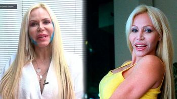 El antes y el después de Alejandra Pradón: pasó por un tratamiento estético