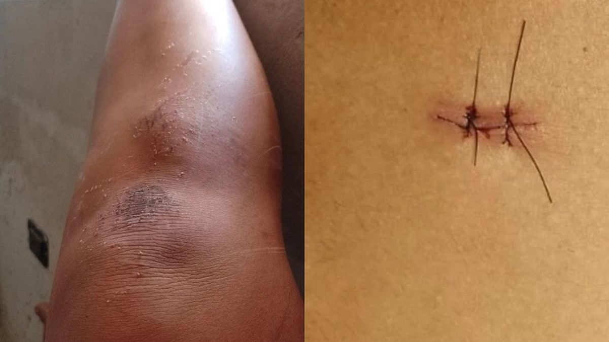 Camila, la hermana de Thiago de Gran Hermano 2022, mostr&oacute; los puntos de sutura que le dieron tras ser apu&ntilde;alada en una pelea vecinal y el resto de las heridas corporales.&nbsp;