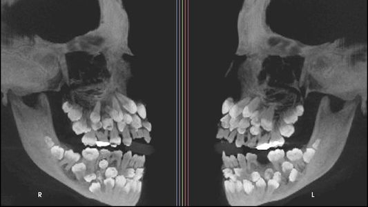 Inédito: nació con 81 dientes e investigan su caso por extraordinario