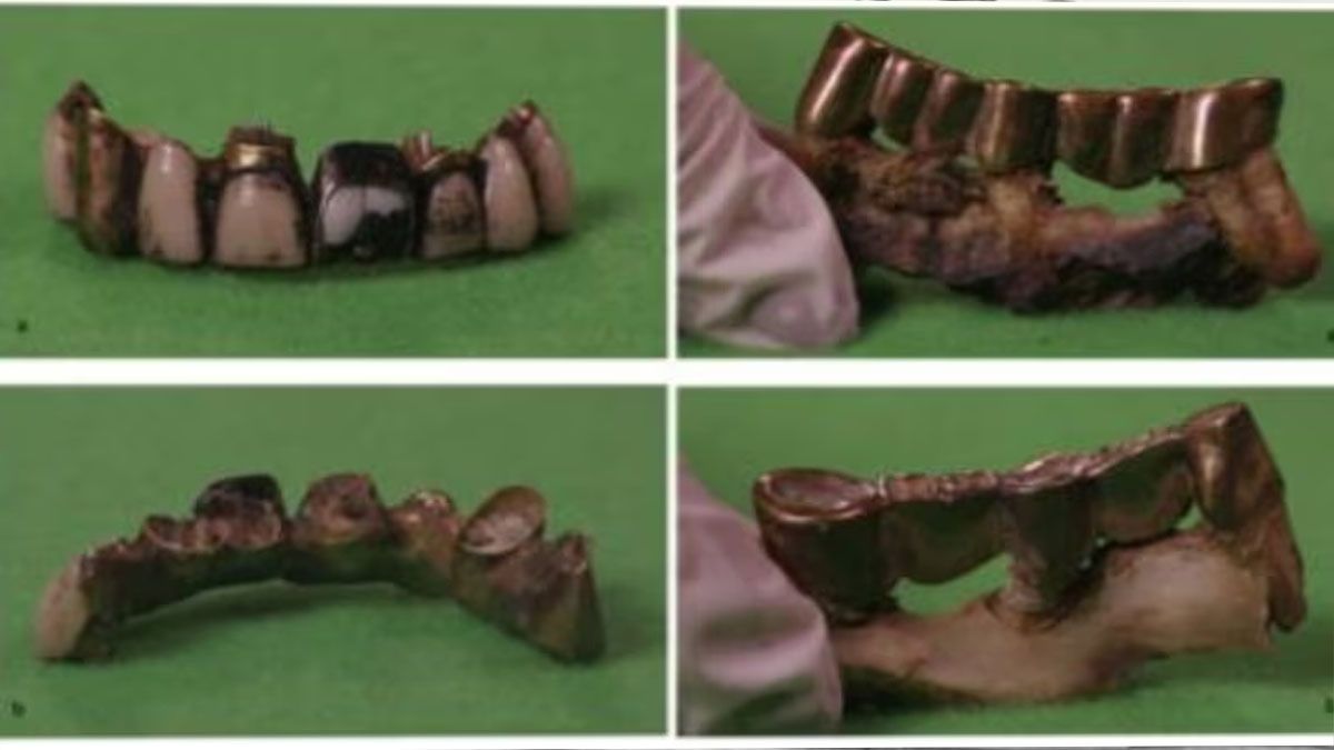 Las piezas dentales, el puente de oro y el arreglo que se hizo hacer Adolf Hitler. La clave para reconocer su cadáver (Foto: captura de TV).
