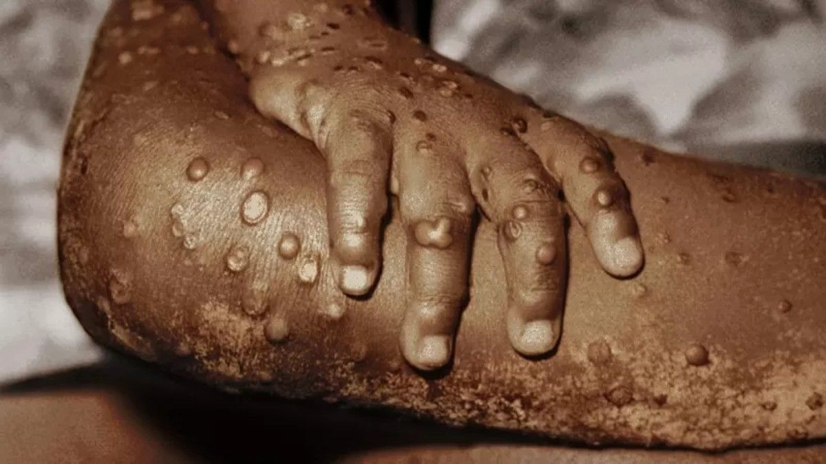 La viruela del mono: el extraño virus que se expande y pone en alerta al mundo. 