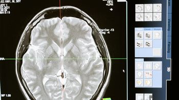Día mundial del cerebro : Consejos para prevenir el deterioro cognitivo