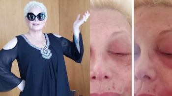 Las impactantes imágenes del rostro de Carmen Barbieri con culebrilla