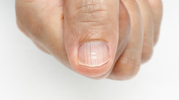 El motivo por el que podés tener las uñas rayadas