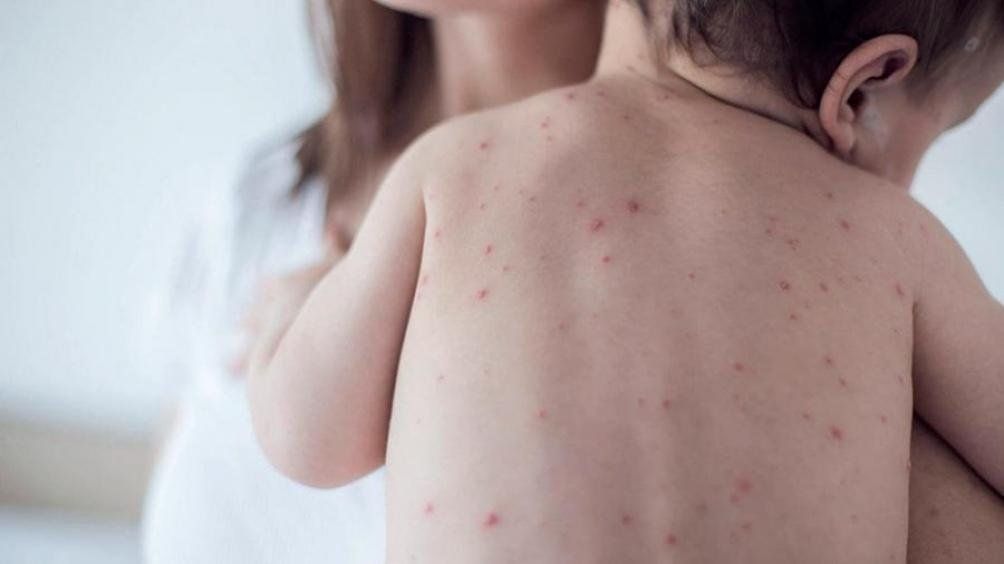 Confirman 144 casos de sarampión, una muerte y un brote activo en AMBA