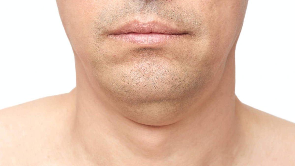 Cómo eliminar la papada de forma definitiva Cómo eliminar la papada de forma definitiva