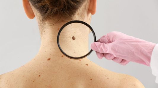 Lunares peligrosos: las señales de alerta que se pueden detectar con un autoexamen